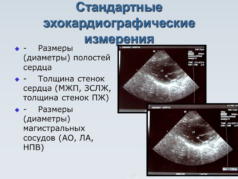 Стандартные эхокардиографические измерения  - Размеры (диаметры) полостей сердца - Толщина стенок сердца (МЖП,